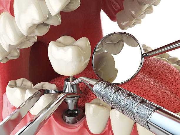 Best Knocked-Out Tooth (Avulsed Tooth) Treatment in Wabash, IN